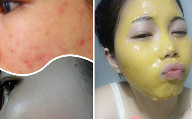 Da sạch boong mụn, sáng mịn nhờ sữa ong chúa
