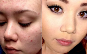 Chỉ 3.000 có ngay công thức trị mụn sáng da cấp tốc bí mật!