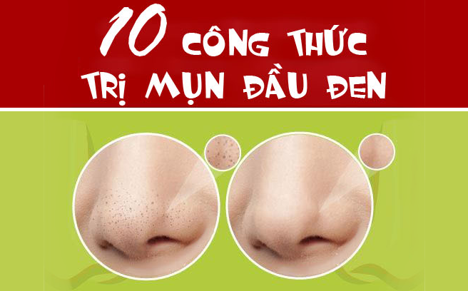 10 công thức loại bỏ mụn đầu đen tại nhà cực hay