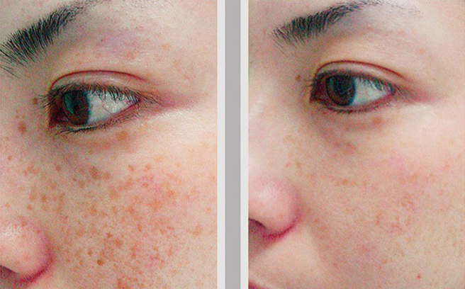 3 mẹo trị tàn nhang không biết sẽ càng hối tiếc