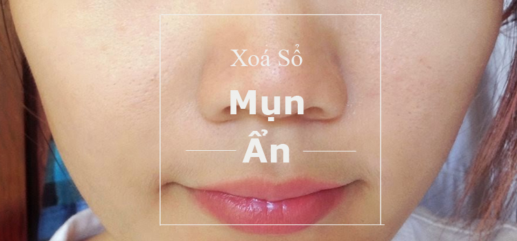 "Xoá sổ" mụn ẩn: chuyện khó mà dễ