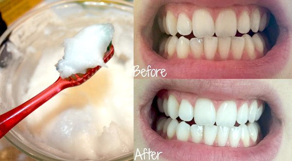 Tự làm hỗn hợp giúp trắng răng, tốt lợi, thơm miệng