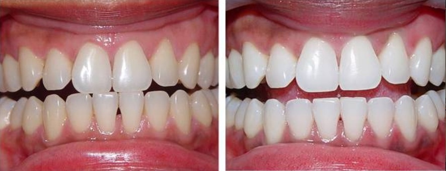 6 phương pháp “tẩy” sạch cao răng chỉ trong 5 phút