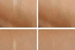 Công thức là mờ sẹo rất hiệu quả ngay cả đối với sẹo lâu năm