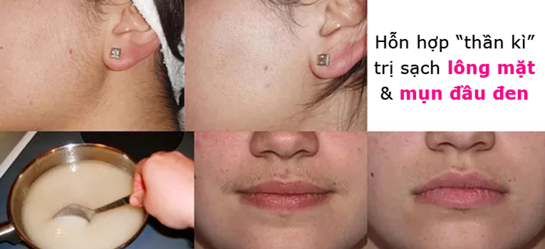 Hỗn hợp “thần kì” giúp trị sạch lông mặt lẫn mụn đầu đen