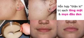 Hỗn hợp “thần kì” giúp trị sạch lông mặt lẫn mụn đầu đen