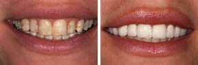 6 Tuyệt Chiêu “Tẩy” Sạch Cao Răng Chỉ Trong 5 Phút