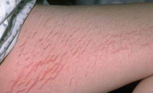 Loại bỏ những vết rạn da bằng những cách vô cùng đơn giản