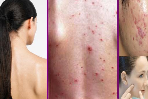 6 phương pháp trị “mụn ở lưng” mang lại hiệu quả bất ngờ