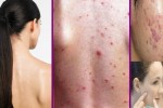 6 phương pháp trị “mụn ở lưng” mang lại hiệu quả bất ngờ