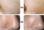 Trị tận gốc hiện tượng lỗ chân lông to