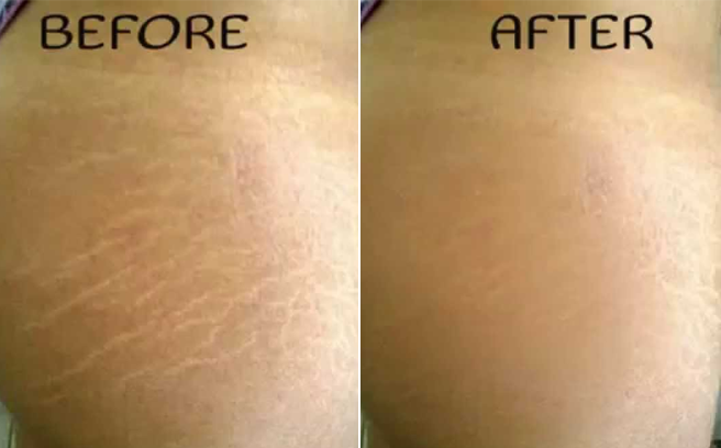 5 bí quyết cực hay giúp giảm vết rạn da nhanh chóng mà không tốn kém