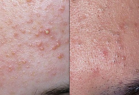 Lương Y “ra tay” trị mụn lâu ngày bằng phương pháp bí truyền