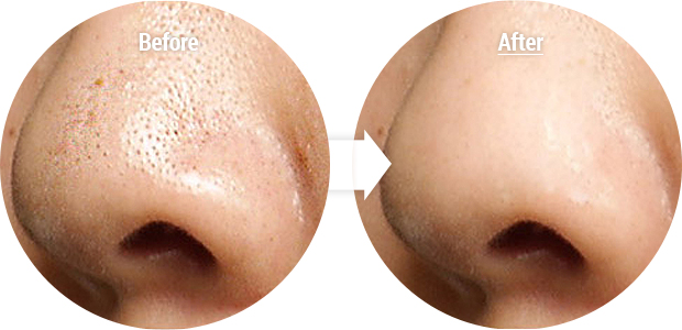 4 mặt nạ se khít lỗ chân lông hiệu quả giúp da mịn màng tự nhiên