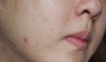 Tôi đã trị mụn thành công chỉ với 30 ngàn đồng!
