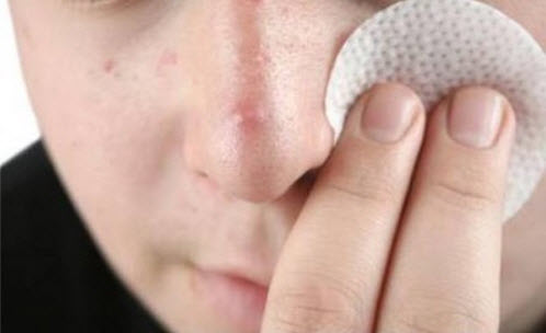 Mẹo Trị Mụn Bọc Siêu Cấp Tốc