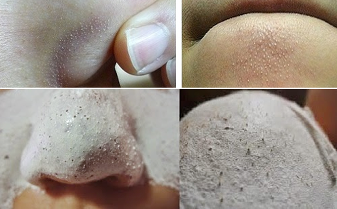 Đánh bay nỗi lo mụn cám với công thức lột mụn tự làm tại nhà