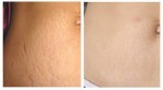 Hỗn hợp giúp chữa rạn da lâu năm hiệu quả