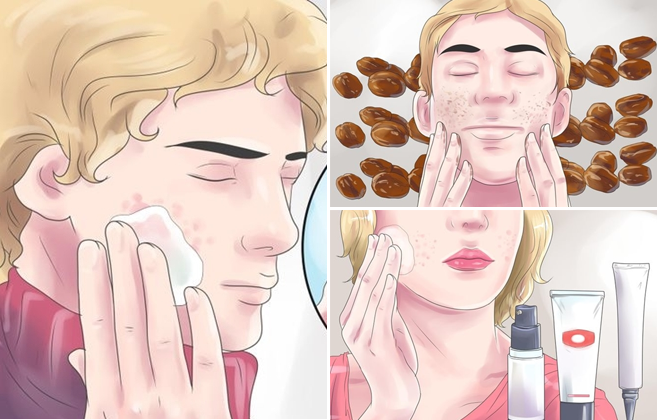Mẹo hay trị mụn siêu tốc bạn chưa từng biết!