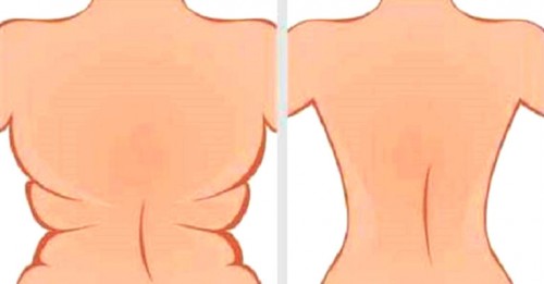 Loại bỏ ngay mỡ thừa vùng nách, lưng và hông chỉ trong 3 tuần