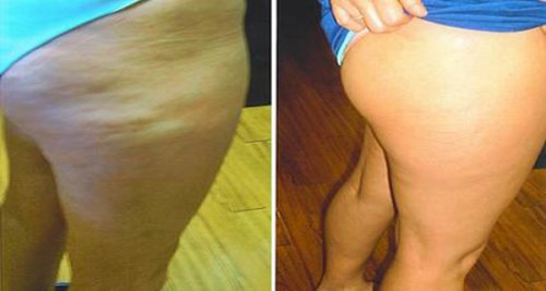 Làm “tiêu tan” mỡ thừa nhanh chóng với quế và mật ong