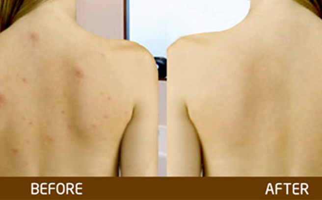 10 tuyệt chiêu giúp đánh bay mụn lưng tại nhà hiệu quả