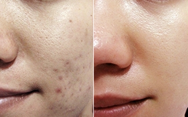 Mẹo hay giúp trị thâm nhanh chóng chỉ với mật ong và vitamin E