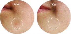 Dùng "bộ trị mụn" sẵn có, em đã trị mụn thành công không tốn 1 đồng