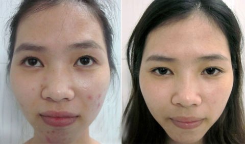 Tôi đã tự chữa mụn và sẹo thâm chỉ từ việc xông hơi hàng ngày