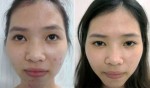 Tôi đã tự chữa mụn và sẹo thâm chỉ từ việc xông hơi hàng ngày