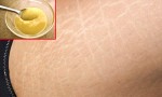 ‘Bái bai’ vết rạn da cực hiệu quả nhờ hỗn hợp đơn giản