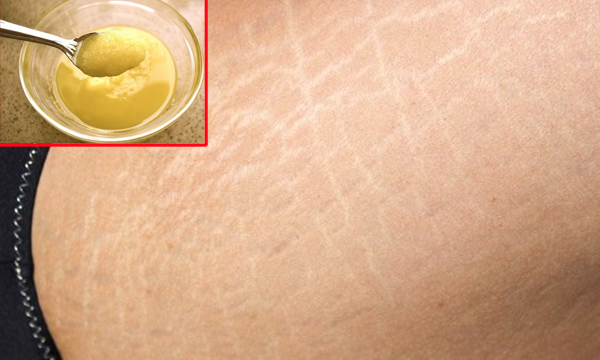 ‘Bái bai’ vết rạn da cực hiệu quả nhờ hỗn hợp đơn giản