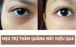 Thổi bay quầng thâm mắt chỉ trong 5’