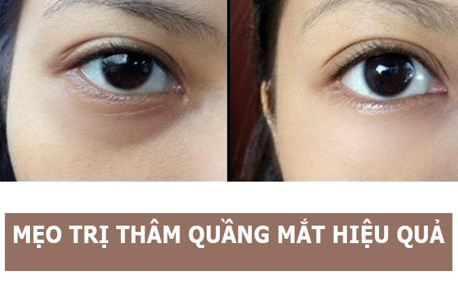 Thổi bay quầng thâm mắt chỉ trong 5’