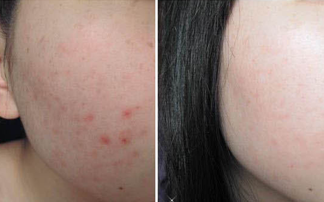 Trị mụn thần tốc với 7 phương pháp đơn giản tại nhà