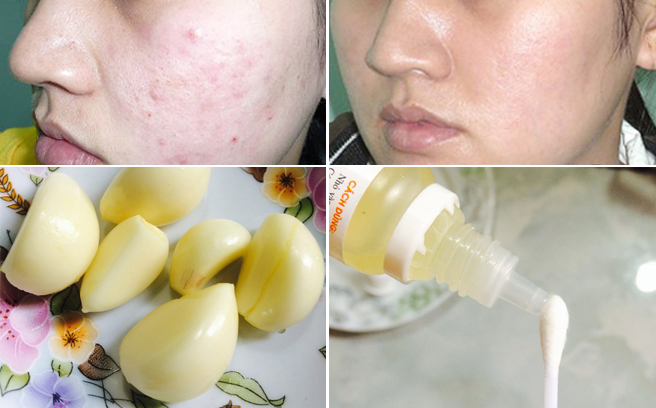 Bí quyết trị sạch mụn chỉ trong vài ngày với tỏi nên thử 1 lần!
