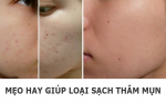 Hết sạch thâm mụn nhờ mẹo hay từ mẹ!