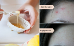 Cứu nguy mụn trên da bằng mật ong và chanh vàng trong 4 ngày!