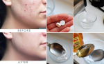 Hướng dẫn trị mụn siêu tốc với Aspirin! Siêu rẻ, siêu đơn giản!