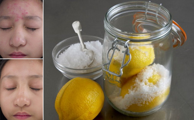 Hướng dẫn bạn cách đơn giản nhất giúp trừ mụn sạch thâm bằng muối siêu hiệu quả