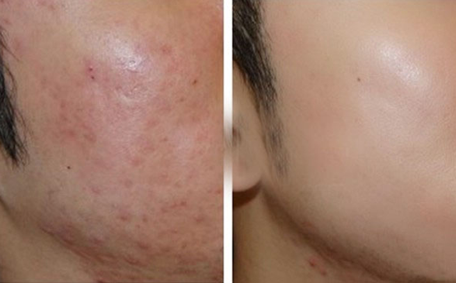 Mẹo hay giúp trị sẹo bằng nguyên liệu tự nhiên an toàn, hiệu quả
