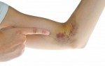 Vết bầm tím da đột nhiên xuất hiện cảnh báo nhiều bệnh