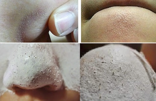 Thử ngay 4 công thức trị mụn đầu trắng với baking soda siêu cấp tốc