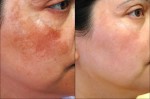 Cách trị nám hiệu quả đón Tết 2016 Bính Thân