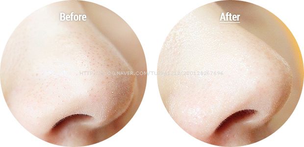 Da đẹp ngỡ ngàng nhờ 6 công thức trị mụn cám siêu tốc
