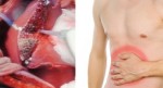 Ở Việt Nam, gần 100% người phát bệnh này chỉ sống chưa được 1 năm