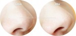 Da đẹp ngỡ ngàng nhờ 6 công thức trị mụn cám siêu tốc