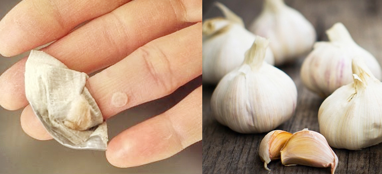 Mụn cóc biến mất vĩnh viễn chỉ nhờ vài nhánh tỏi