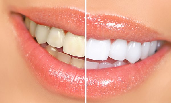Hàm răng trắng sáng, hết mảng bám với những bí kíp cực độc đáo
