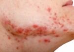 "Đuổi tận diệt tuyệt" mụn trứng cá quanh hàm và cằm